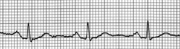 ECG - Electro Cardio Graph